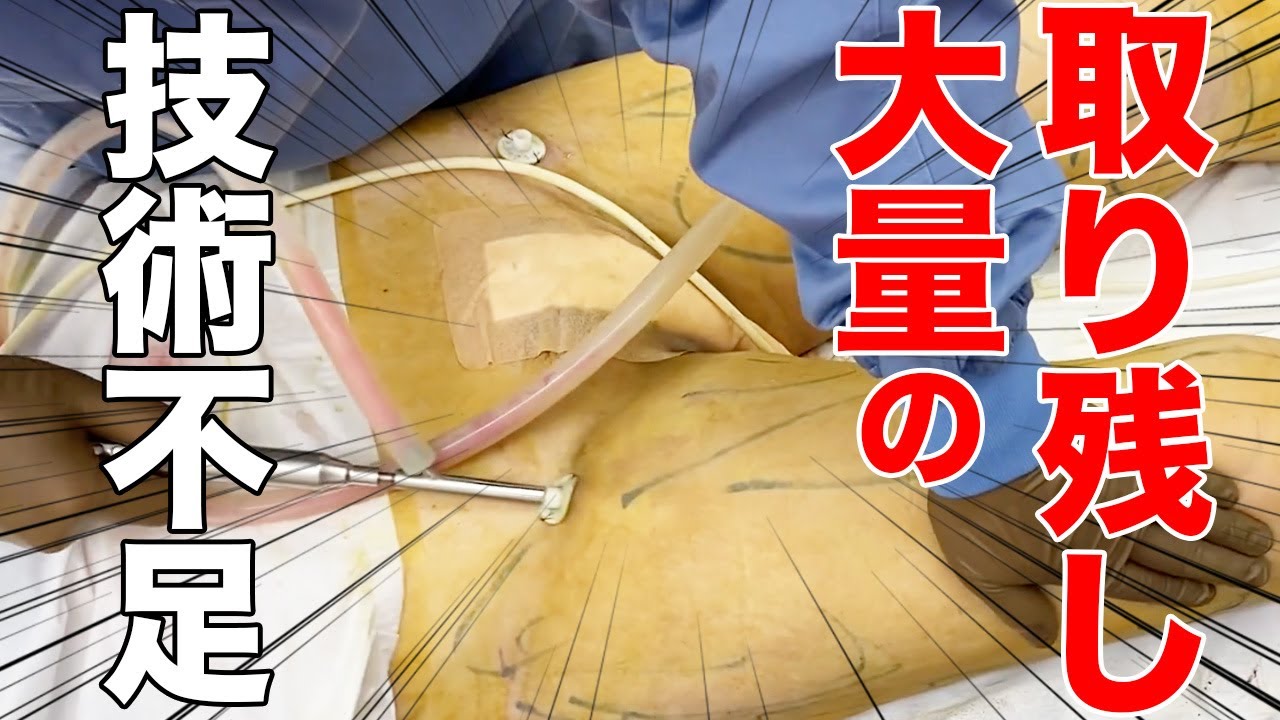 脂肪吸引 失敗】他院で再手術を断られ駆け込んできたお客様！大量の