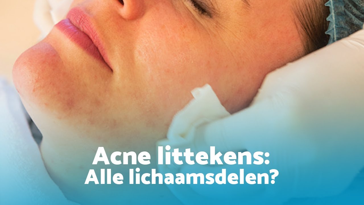 Kunnen acne littekens op alle lichaamsdelen behandeld worden?