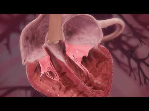 Transcatheter Mitral Valve Replacement (TMVr) using MitraClip