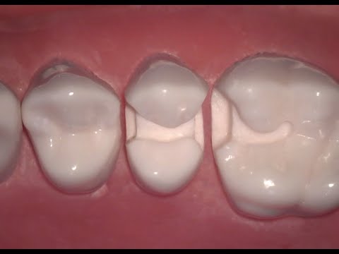 #13 MOD Composite Preparation