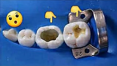 Quanto custa para fazer uma obturação no dente?