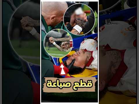 لقطة مرعبة إصابة انتهت بقطع صباع لاعب قدام العالم