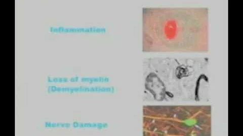 Part 1, Multiple Sclerosis Symposium UMHS 2011