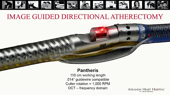 Pantharis and Image-Guided Atherectomy - Ian Cawich, MD