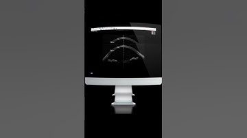 MS-39 Corneal topography and tomography of the anterior segment