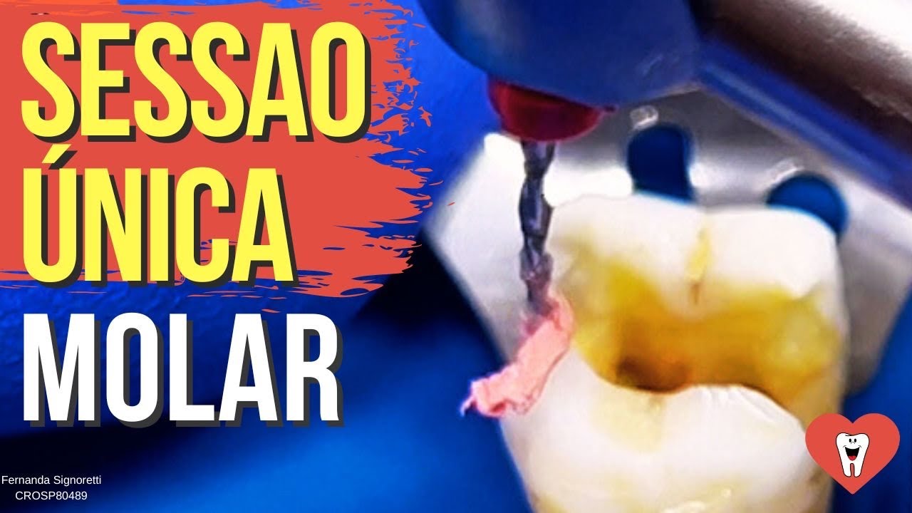 ENDODONTIA RETRATAMENTO EM SESSÃO ÚNICA - PASSO A PASSO - Endolovers