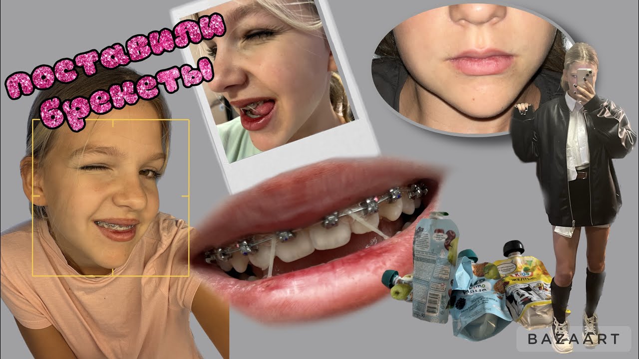 *ставлю БРЕКЕТЫ* ❤️ недельный влог+ удаление зуба мудрости*