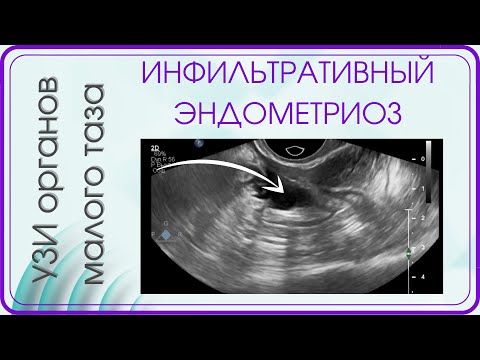 Глубокий инфильтративный эндометриоз сигмовидной кишки