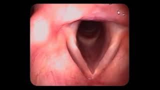 Vocal Folds Revealed