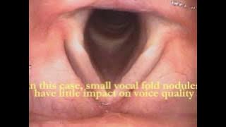 Vocal Folds Revealed