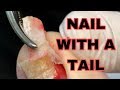 Ingrown Toenail With A Tail. Ingrown Nail Removal.