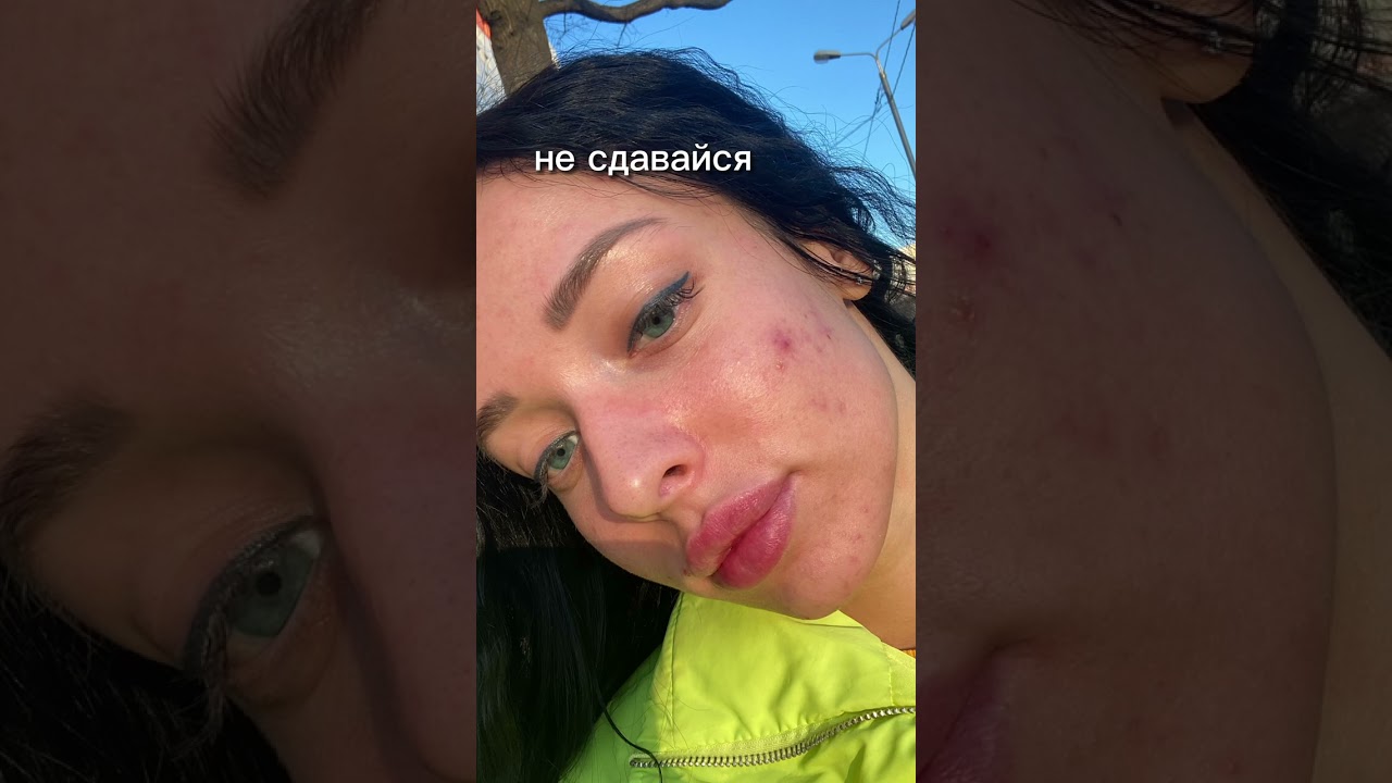 Я ИЗБАВИЛАСЬ ОТ ПРЫЩЕЙ ЗА ОДИН ДЕНЬ! 😭