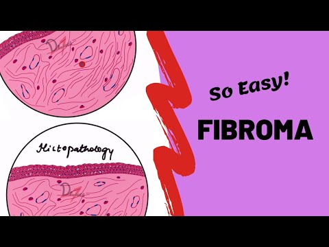 Video: Fibroma Of The Oral Cavity - Causes And Symptoms Of Fibroma Of The Tongue And Fibroma Of The Gums