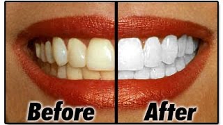 How to Whiten Teeth تبيض الأسنان