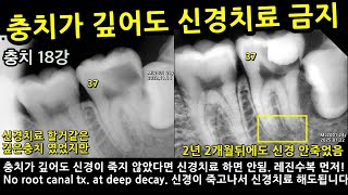 충치가 깊어도 신경치료 금지. 레진빌드업 이중구조. 신경이 죽으면 노크라운 기둥레진. 충치원인은 교합. 교합구조붕괴. 신경치료18강 충치18강 2025_03_08