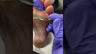 Dive into the world of Podiatry with our Aussie experts step-by-step forefoot callus removal Podi