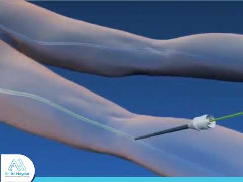 Arterial Embolism Dr Ali Haydar علاج جلطة الأوردة العميقة في الساق