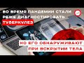 Во время пандемии стали реже диагностировать туберкулез, но его обнаруживают при вскрытии тела