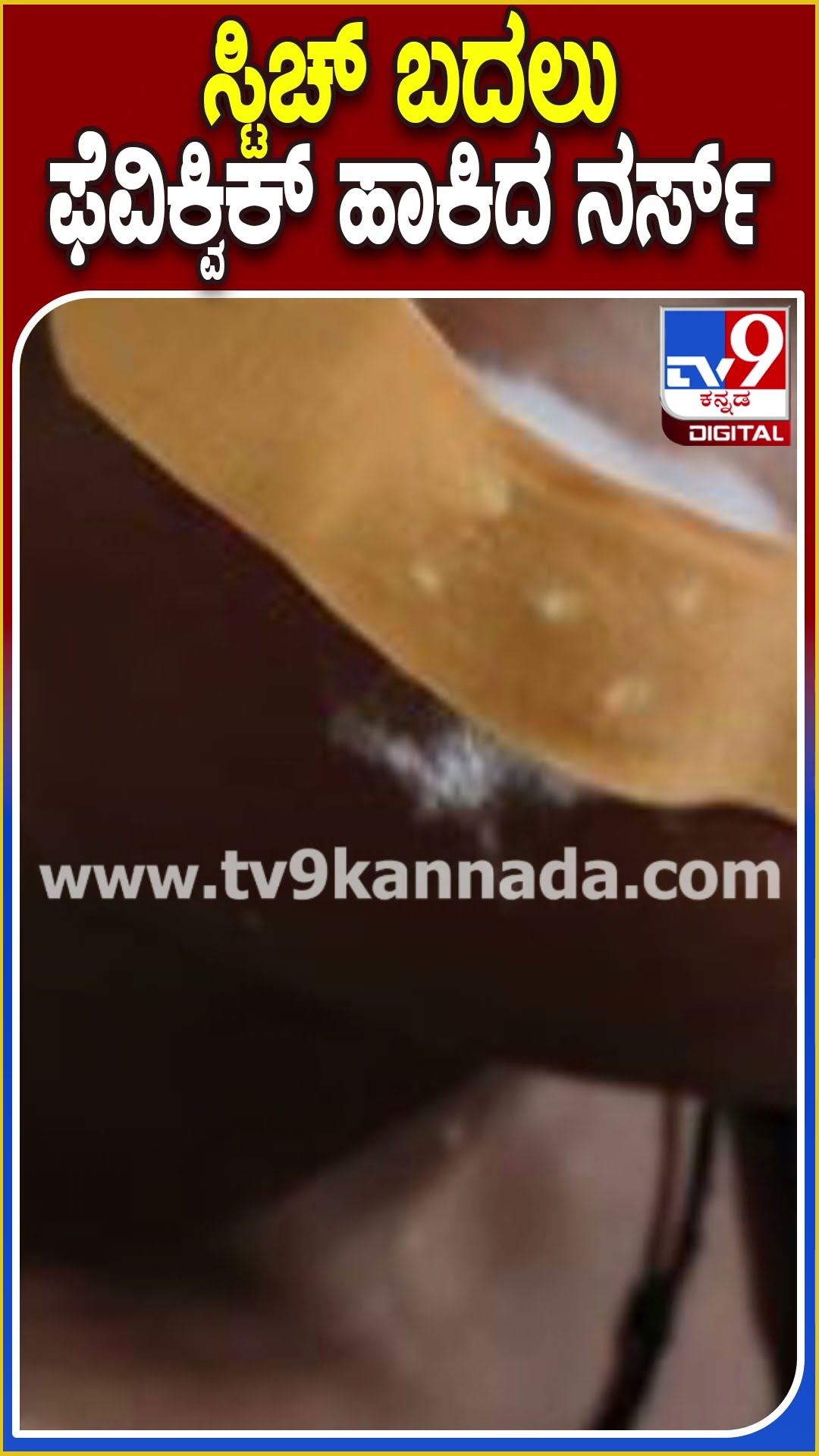 ಸ್ಟಿಚ್ ಬದಲು ಫೆವಿಕ್ವಿಕ್‌ ಹಾಕಿದ ನರ್ಸ್!​ #Nurse #Tv9D