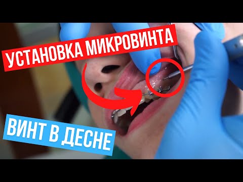 Микровинт для брекетов. Микроимплантация в ортодонтии.