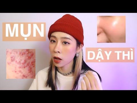 GIVEAWAY | TÂM SỰ MỤN TUỔI DẬY THÌ | DECUMAR ADVANCED TRỊ MỤN CÓ TỐT KHÔNG?