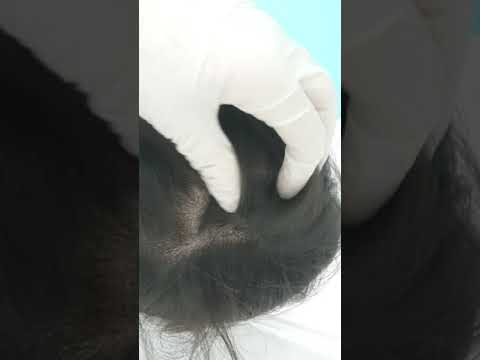 Fresh SMP Density Restoration Scalp Micropigmentation by El Truchan