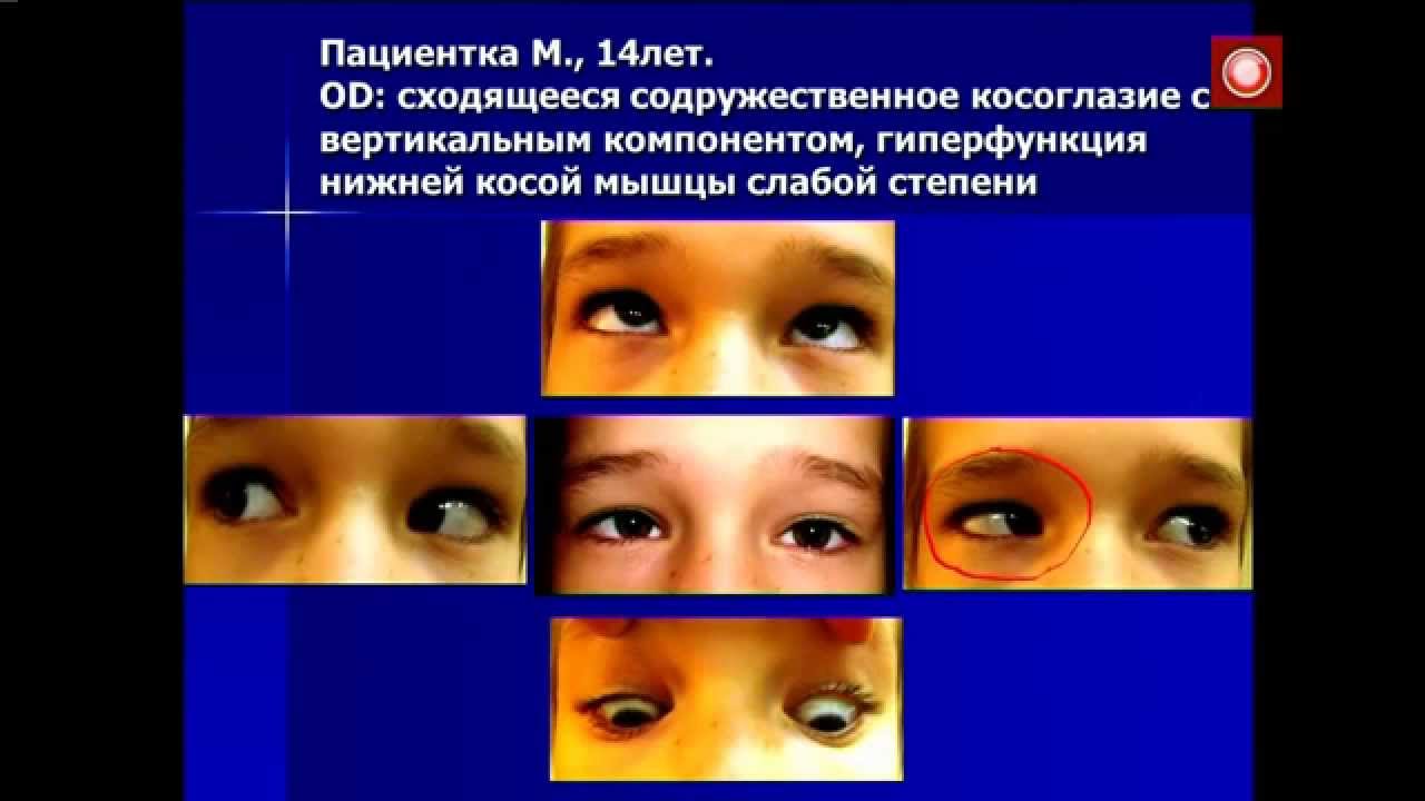Хирургическое лечение косоглазия с гиперфункцией... - YouTube