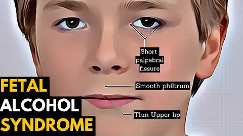 Can a doctor tell if your baby has fetal alcohol syndrome?