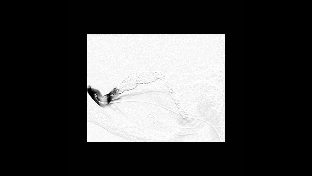 Technques Dural Fistula Case 2 Post Embo Sigmoid sinus opened
