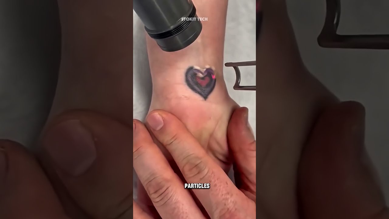 Where Does Tattoo Ink Go After Laser Removal The Surprising Truth