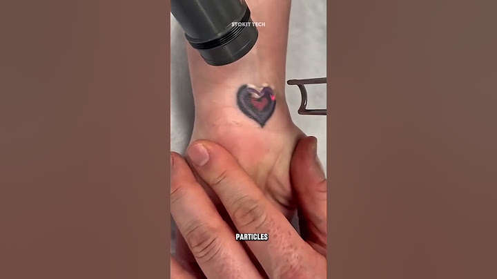 Where Does Tattoo Ink Go After Laser Removal? The Surprising Truth