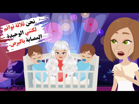 نحن ثلاثة توائم لكنني الوحيدة المصابة بالبرص عائلتي لا تحبني