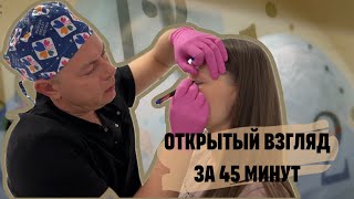 Убрали нависающее верхнее веко