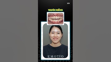 Tháo niềng khớp cắn hở tại Nha Khoa No1#nhakhoano1  #niengrangdanang