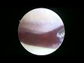 Knee meniscus repair with a prp injection 1 11 24 df