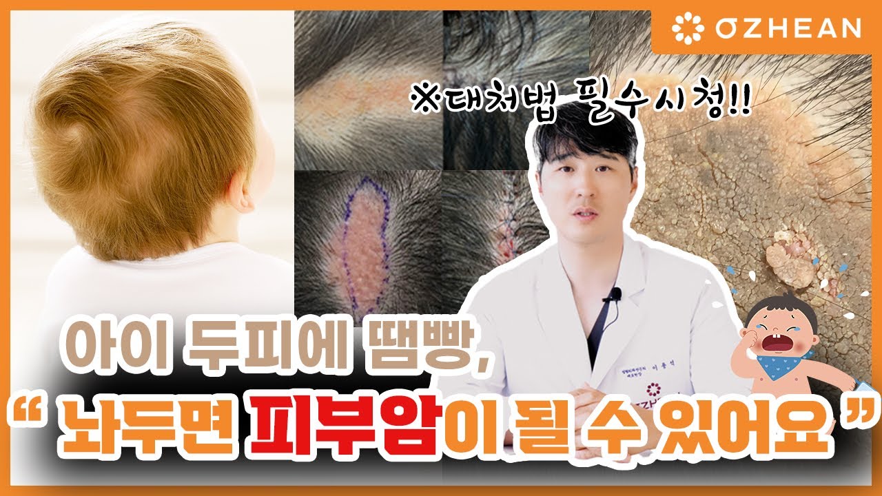 피지샘 모반이 피부암이 될 수 있다고?ㅣ피부암 ㅣ 초기에 제거해야 하는 이유 ㅣ 두피 혹 ㅣ 아이 탈모 ㅣ 선천성 모반 ...
