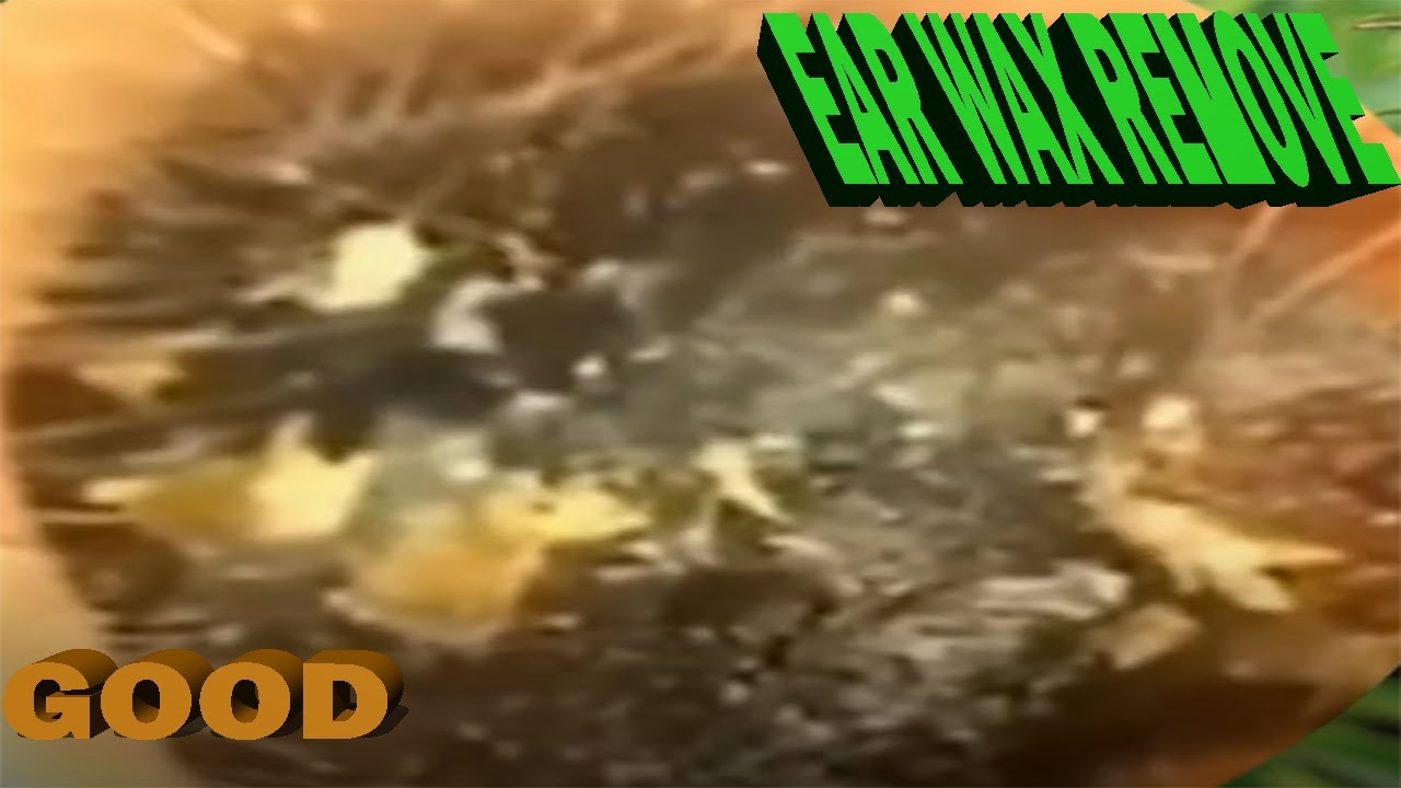 THE BIGGEST PIECE OF EAR WAX REMOVED...EVER! .ear wax removal EP135 YouTube