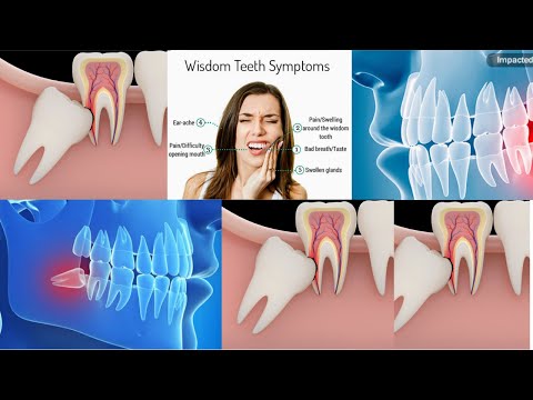 What are wisdom teeth(wisdom teeth removal surgery) Animation video
