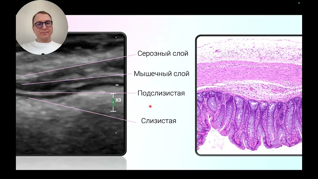 Ультразвуковая диагностика опухолевой патологии толстой  кишки. Запись вебинара. Автор Сниткин В.М.