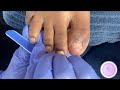 Pedicure on Damaged Toenail