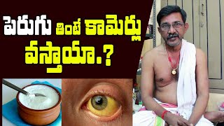 పెరుగు తింటే కామెర్లు వస్తాయా.? Can we eat Curd during Jaundice