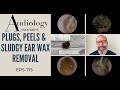 PLUGS, PEELS &amp; SLUDGY EAR WAX REMOVAL - EP715