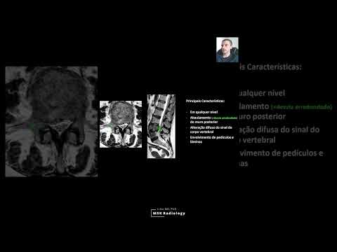FRATURAS PATOLÓGICAS: PRINCIPAIS