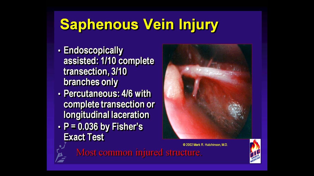 166 Chronic Exertional Compartment Syndrome YouTube