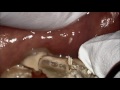 Plaque Coming Off Teeth In Chunks