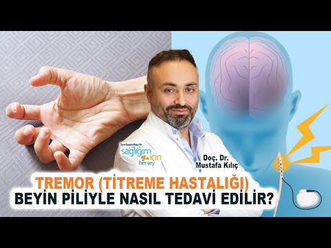 Tremor (Titreme Hastalığı) Beyin Piliyle Nasıl Tedavi Ediliyor?