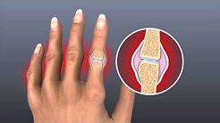 Rheumatoid Arthritis - Mayo Clinic