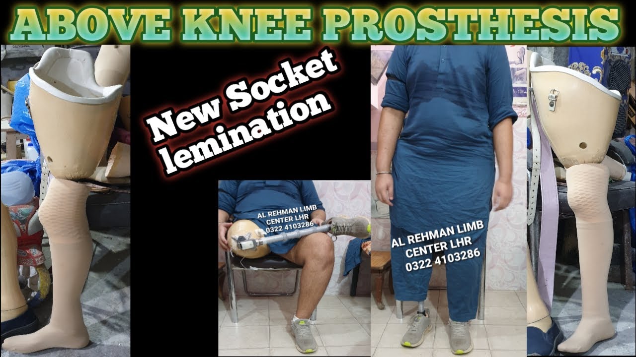 Above knee prosthesis Germany +u.s.a new socket lemination 