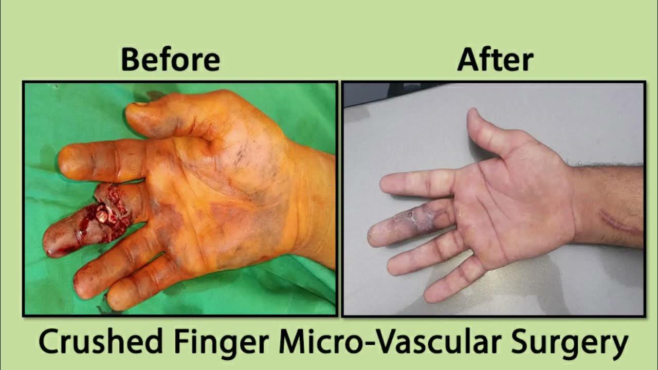 Hand Injury, Body Part Rejoining Reattachment, Replantation, Hand