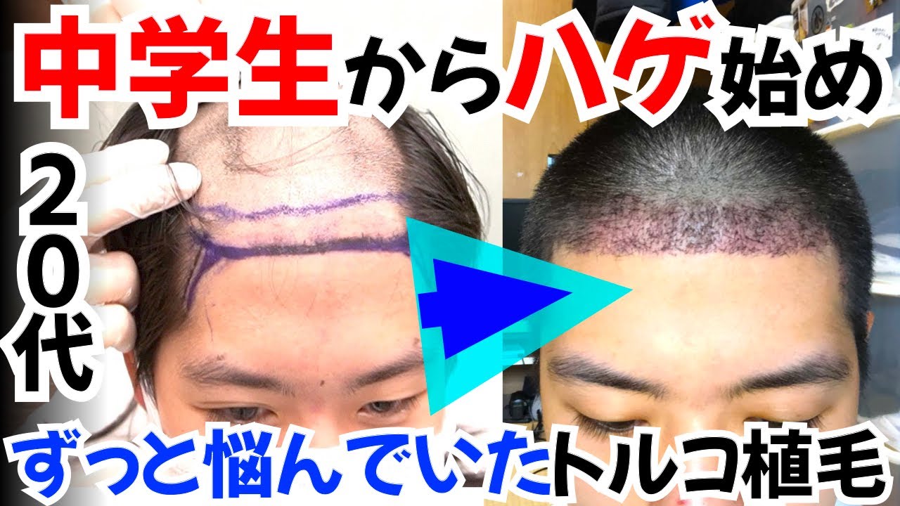 体験談】中学生からハゲ始め 若ハゲを改善するために自毛植毛!! - YouTube